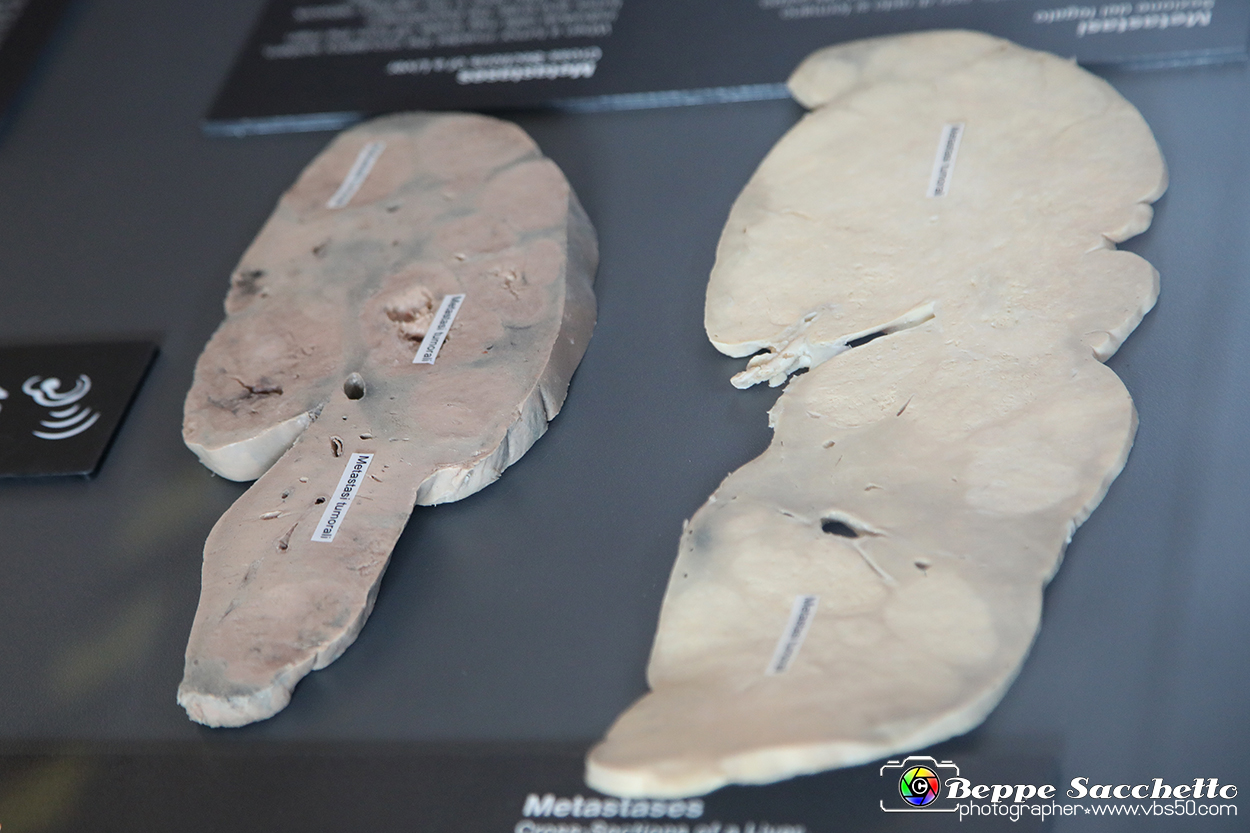 VBS_2716 - Sezioni del fegato - Metastasi - Mostra Body Worlds.jpg